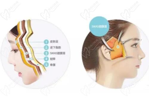 無(wú)痕筋膜提升和線提升根本不是一回事！四大核心區(qū)別解析